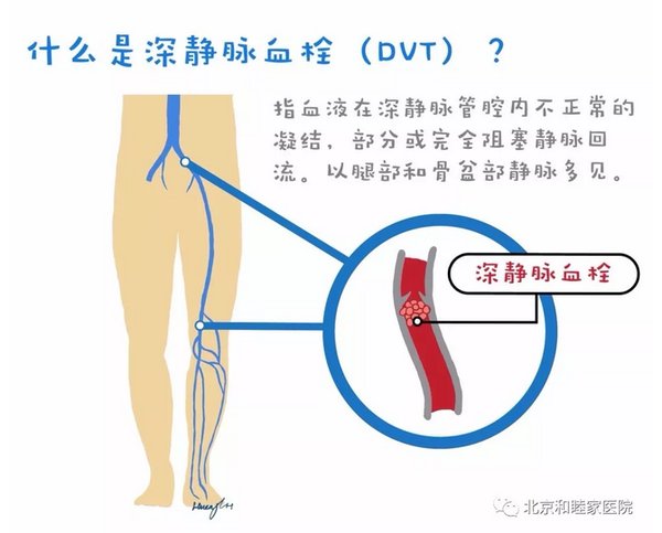 下肢深静脉血栓示意图（黄柳桓医生制图）