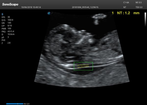 超声Auto NT功能展示