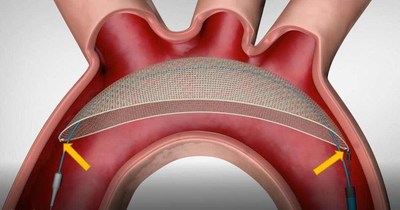 TriGUARD 3(TM)抗栓塞远端保护装置